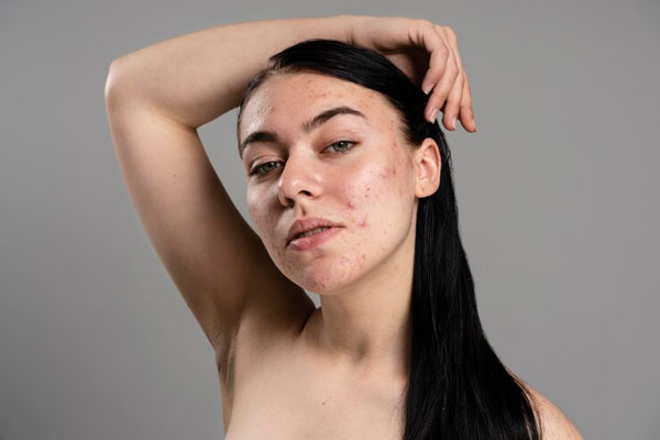 Aceite de ricino para el pelo - Joven con acné muestra su rostro sin maquillaje y sin complejos 