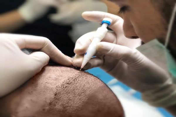 Técnica DHI de injerto capilar - Vista ampliada de un proceso de implantación de cabello en una de las mejores clínicas de México 