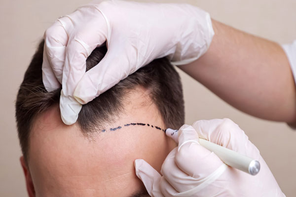 Técnica DHI de injerto capilar - Cirujano capilar dibuja línea de implantación frontal para trasplante de cabello