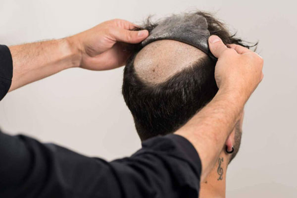 Prótesis capilar - Estilista trabaja minuciosamente para disponer pieza de cabello natural en un cliente con calvicie en la coronilla