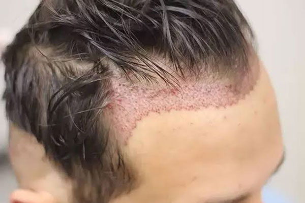 Proceso de recuperación de implante capilar en el área frontal del cuero cabelludo de un hombre 