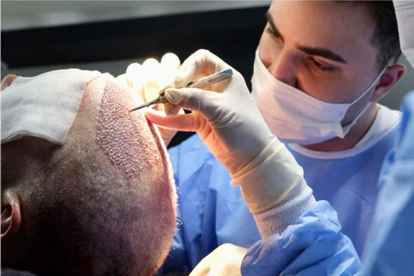 Técnica DHI de injerto capilar - Expertos en técnica FUE trasplantan unidades foliculares para cubrir la zona superior del cuero cabelludo de un paciente 
