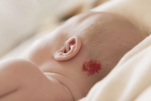 Hemangioma capilar - Bebé acostado de lado con marca de fresa en la parte posterior de la cabeza 