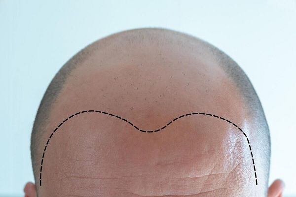  Técnica DHI de injerto capilar - Hombre con calvicie avanzada apuesta por un tratamiento quirúrgico para recuperar el cabello 