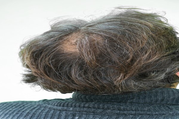 hombre de espaldas con el cabello de su cabeza afectada por este problema capilar