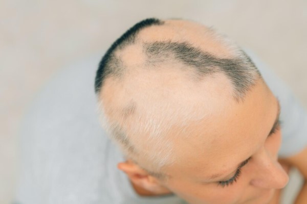 mujer con claros sintomas de alopecia areata en su cabeza