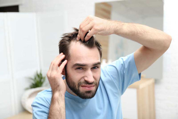 Alopecia en jóvenes - Joven con barba nota con desagrado el avance de sus entradas en la sien