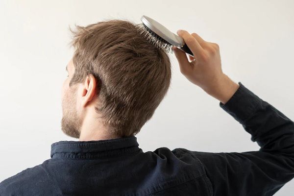 alopecia en jovénes