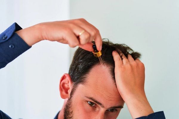 Alopecia juvenil - Hombre joven aplicando gotas medicinales en el cuero cabelludo, para estimular el crecimiento capilar