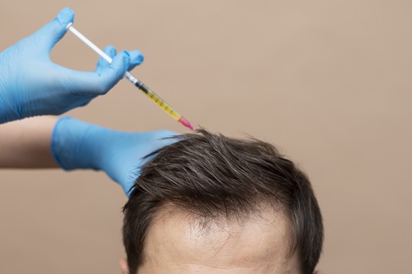 Hombre recibiendo un tratamiento de Plasma Rico en Plaquetas, el cual estimula el crecimiento capilar y detiene la caída del pelo