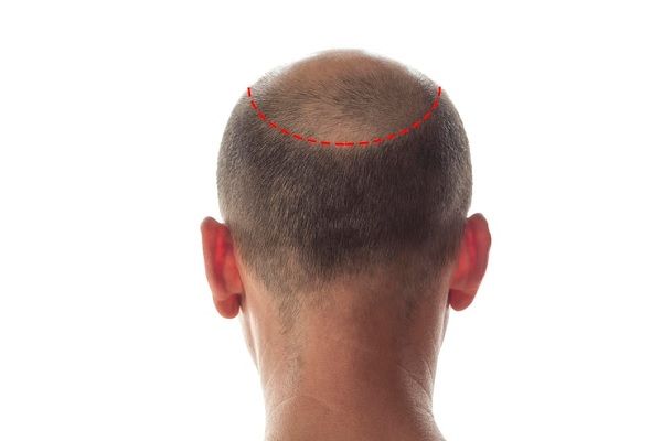Hombre con densidad de cabello irregular en la zona de la coronilla, luego de un injerto de pelo realizado inadecuadamente