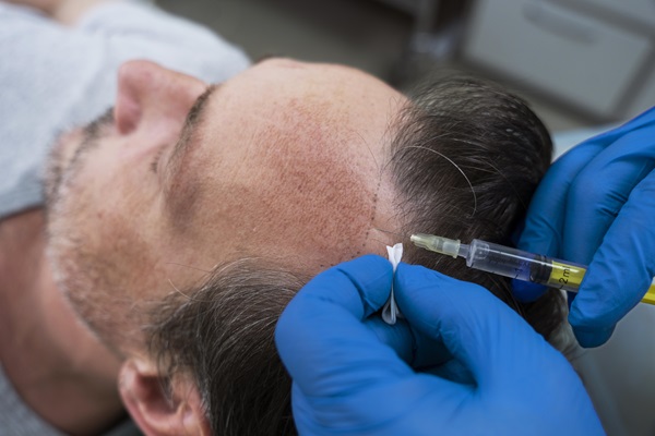 Hombre recibiendo un tratamiento de implante capilar, el cual permite recuperar el pelo natural en las zonas afectadas por la calvicie