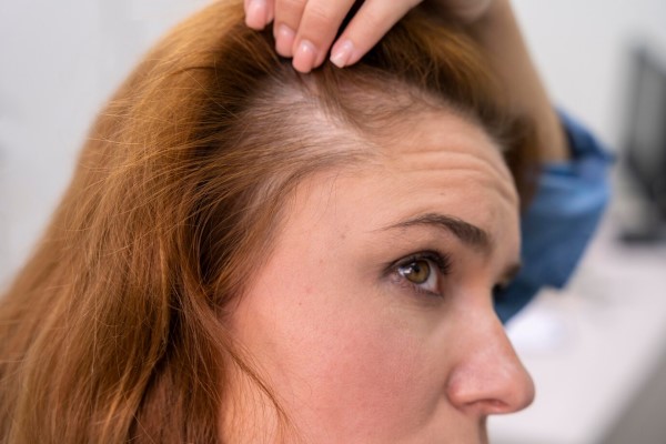 Alopecia androgénica en mujeres - mujer revisando la perdida de densidad capilar en la sien