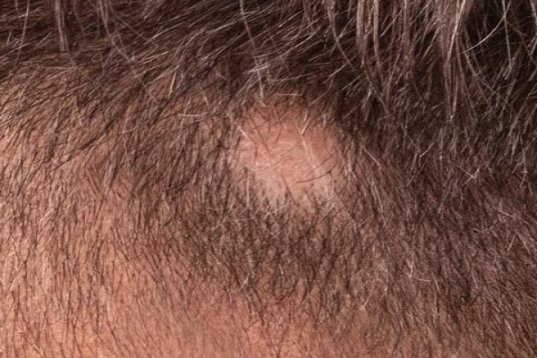 alopecia en niños - imagen del síntoma más característico de la alopecia areata