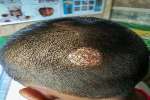 alopecia en niños - Infección bacteriana secundaria por anillo del cuero cabelludo de un niño asiático