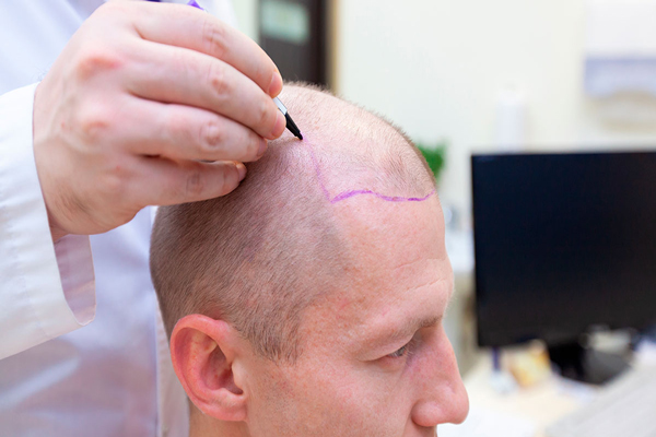 Tricólogo traza línea de implantación frontal como paso previo para preparar a un paciente para un injerto capilar
