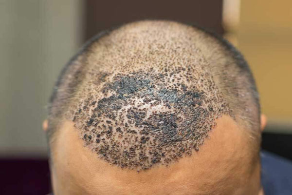 Recomendaciones tras trasplante capilar - Plano detalle de la formación de costras en el cuero cabelludo de un paciente como parte del proceso de cicatrización natural tras implante de cabello