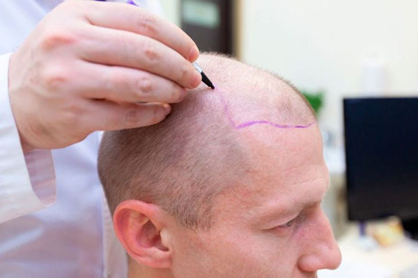 Dermatólogo en el injerto capilar - Cirujano capilar traza línea de implantación frontal en el cuero cabelludo de un paciente con alopecia 