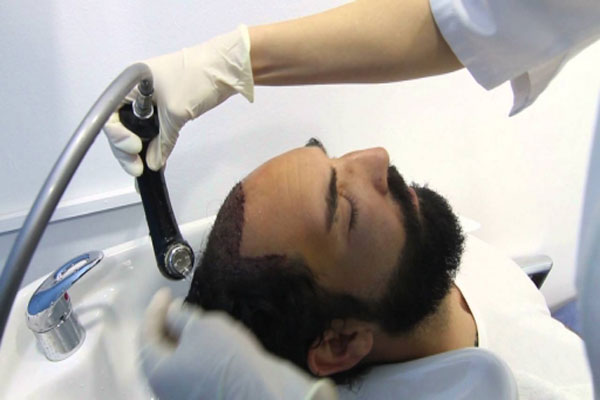Recomendaciones tras trasplante capilar - Personal especializado colabora con el lavado del cuero cabelludo de un paciente