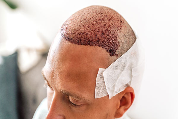 Recomendaciones tras trasplante capilar - Paciente masculino con alopecia avanzada se recupera de una cirugía para devolverle la jovialidad a su imagen