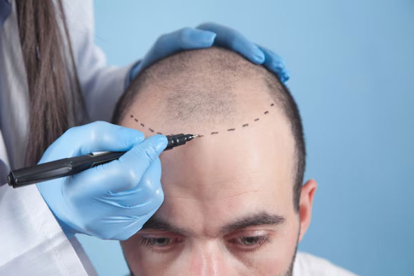 Recomendaciones tras trasplante capilar - Tricólogo traza línea de implantación frontal en el cuero cabelludo de un paciente con problemas de alopecia