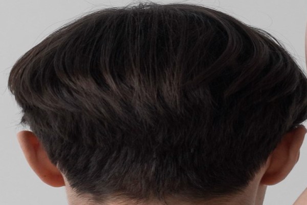 vista trasera de la cabeza donde se encuentra el área donante para un trasplante de cabello