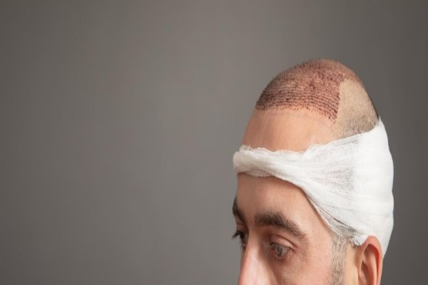 paciente de trasplante de cabello con costras en la cabeza