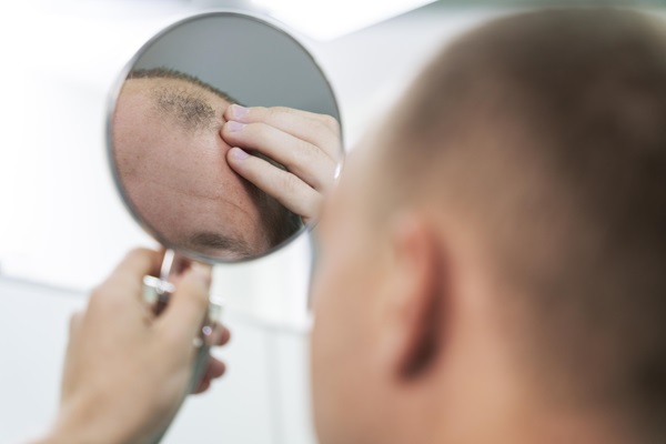 Caída del cabello - Hombre con alopecia observa en un espejo el avance de la pérdida de cabello