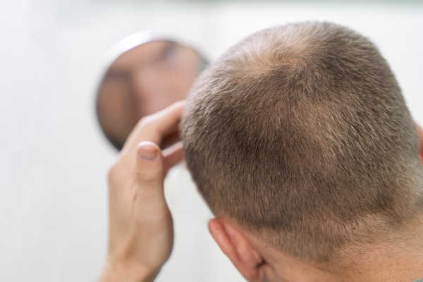 Deportes tras un injerto capilar - Hombre con alopecia toca su cabeza mientras observa en un espejo el avance de la pérdida de cabello