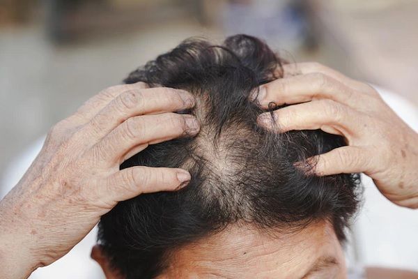 alopecia en la menopausia - mujer con la manos en la cabeza con signos claros del adelgazamiento de su cabello