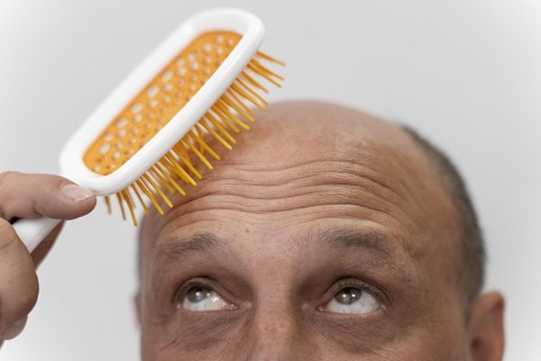 Hombre con alopecia coloca un peine en su cabeza
