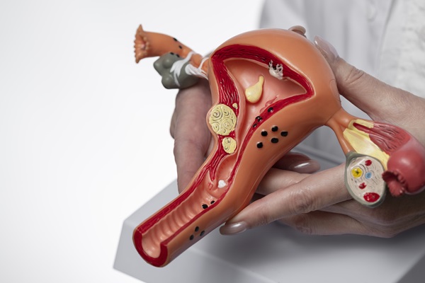 Síndrome de ovario poliquístico - Médico especialista sostiene en sus manos un modelo de útero y ovario