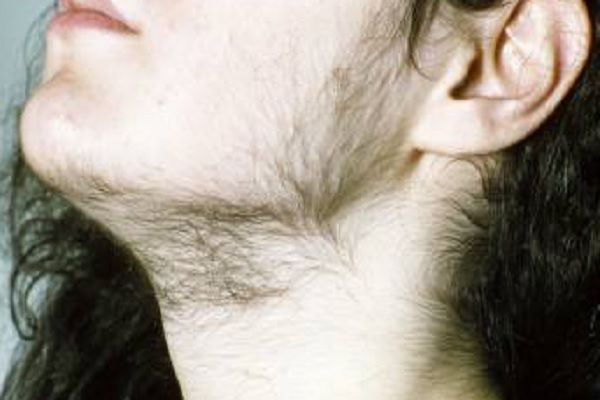 hipertricosis - joven con una cantidad anormal de vello en la mandibula