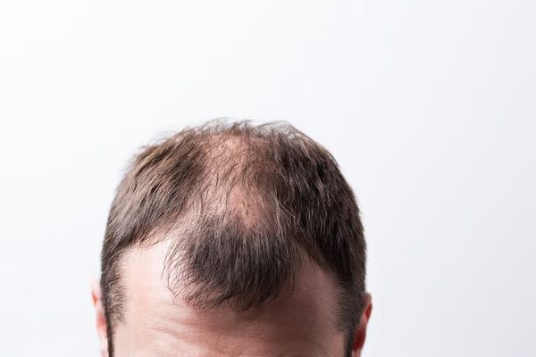 shock loss tras el injerto capilar - cabeza de un hombre con claros signos de alopecia en la línea del cabello, las entradas y la coronilla