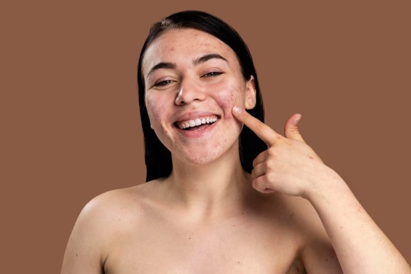 hirsutismo hormonal - mujer mostrando sonriente el acné de su rostro