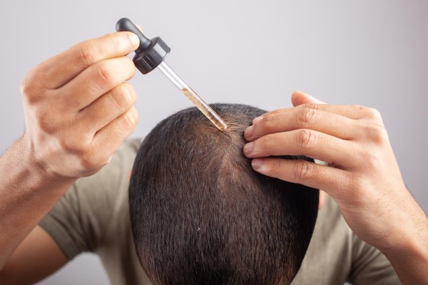 Efecto Shedding - hombre aplicando un tratamiento capilar en su cabello con un cuentagotas para tratar su alopecia en la coronilla