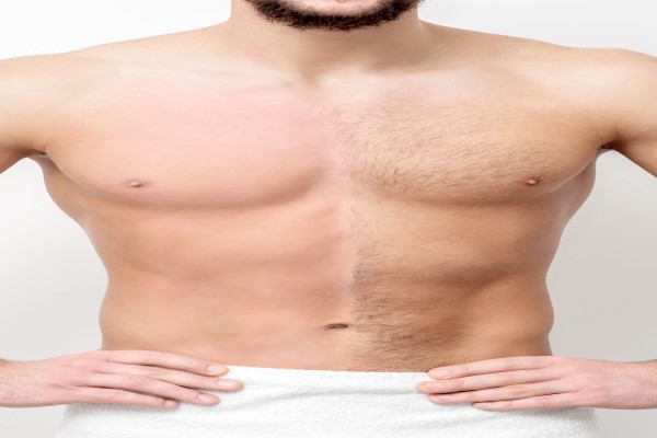 hipertricosis - efectos de la depilación en el torso de un hombre