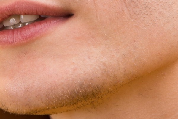 mentón de una mujer con hirsutismo