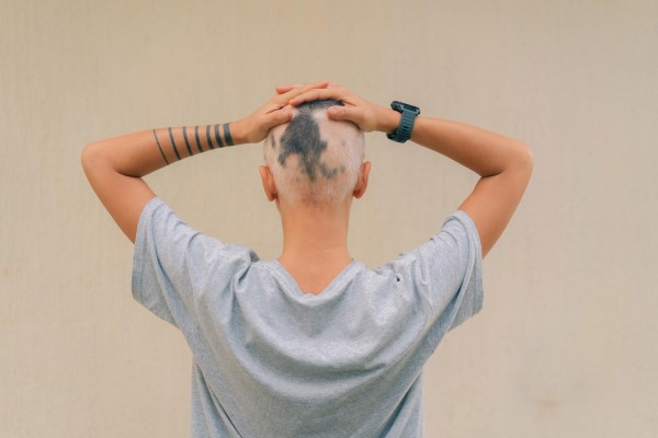  mujer con las manos en la cabeza afectada por la alopecia areata
