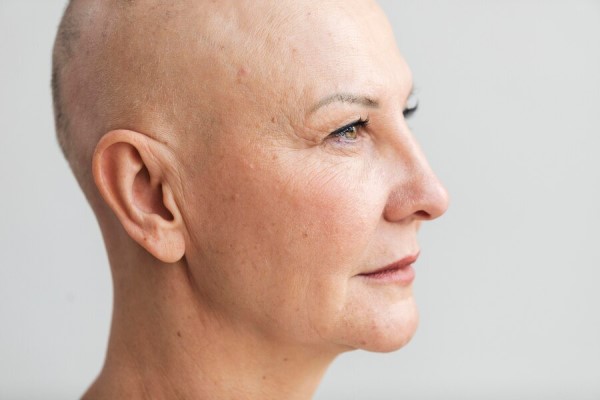  vista lateral de la cabeza de una mujer en fase avanzada de alopecia universal