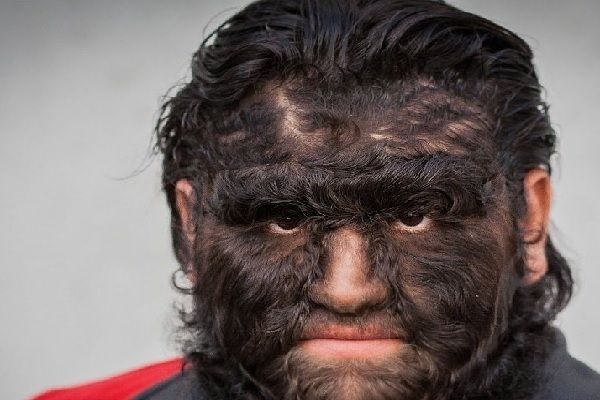 hipertricosis - imagen de un hombre con todo el rostro cubierto de vello