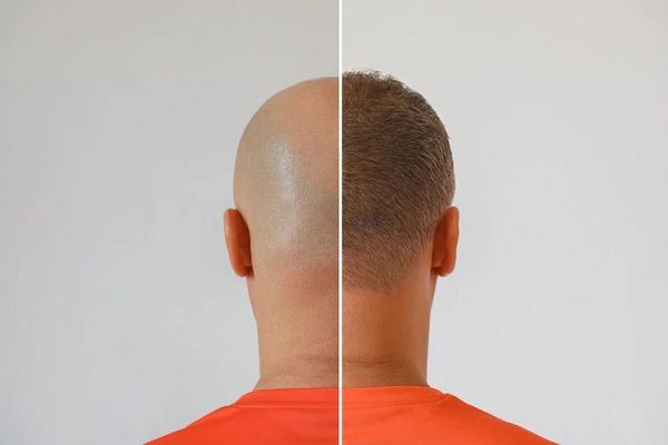 Implante capilar a los 50 - imagen del antes y después de injerto de cabello en un hombre