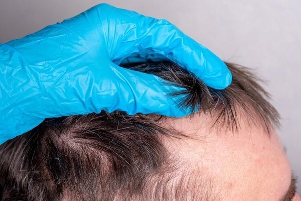 Implante capilar a los 50 - especialista revisando la salud del cabello de un paciente