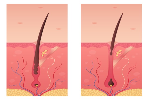 dibujo con las fase telógena del crecimiento del cabello