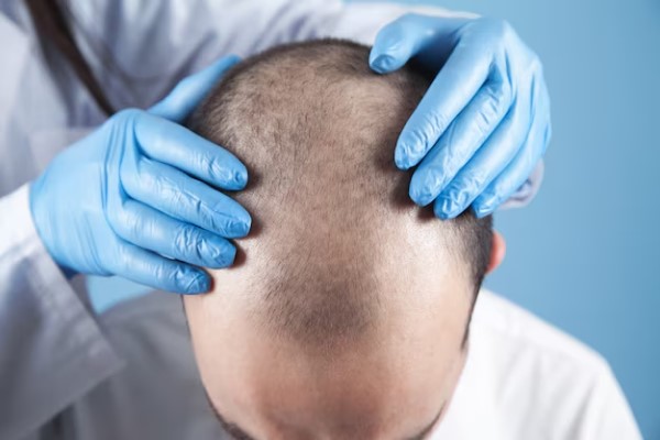 tricólogo revisando los problemas de alopecia androgénica de un paciente