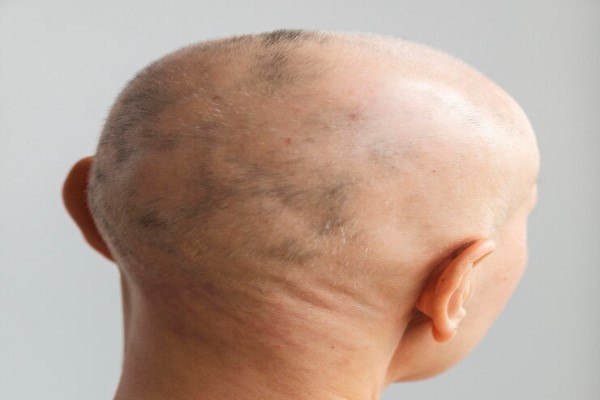 mujer con problemas severos de caída del cabello
