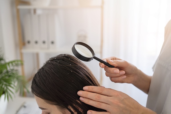 Alopecia seborreica - Persona observando con una lupa la caspa en el cabello de una mujer
