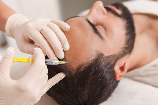 Hombre con entradas recibe un tratamiento de mesoterapia capilar para estimular el crecimiento del cabello 
