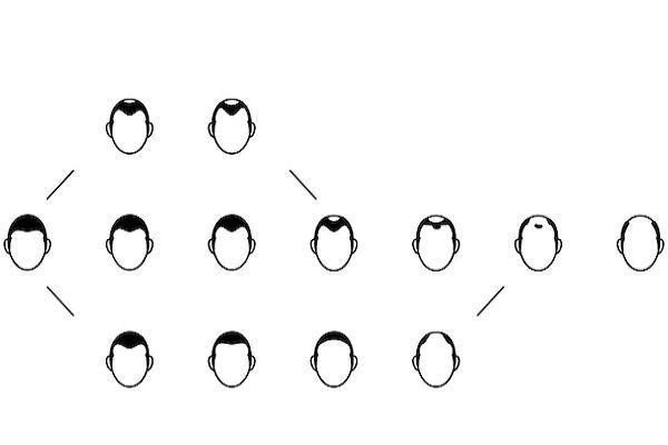 Grados de alopecia - Ilustración gráfica de los distintos tipos de calvicie masculina