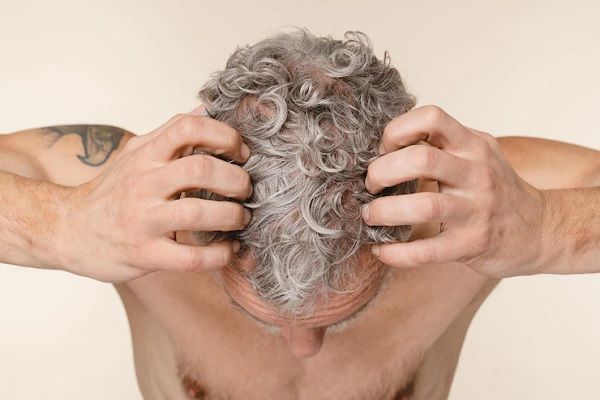 Grados de alopecia - Plano cenital de la cabeza de un hombre canoso con pérdida de cabello 